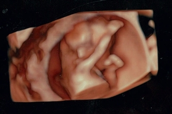 双子,妊娠,旅行,外出クリフムで出生前診断